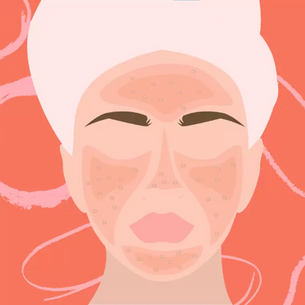 Rosácea - informações e conselhos de uma dermatologista!