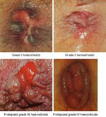 Thumbnail: BUASIR / HAEMORRHOID PRIMAHERBS FORMULA (PROMO B / 2 BOTOL)