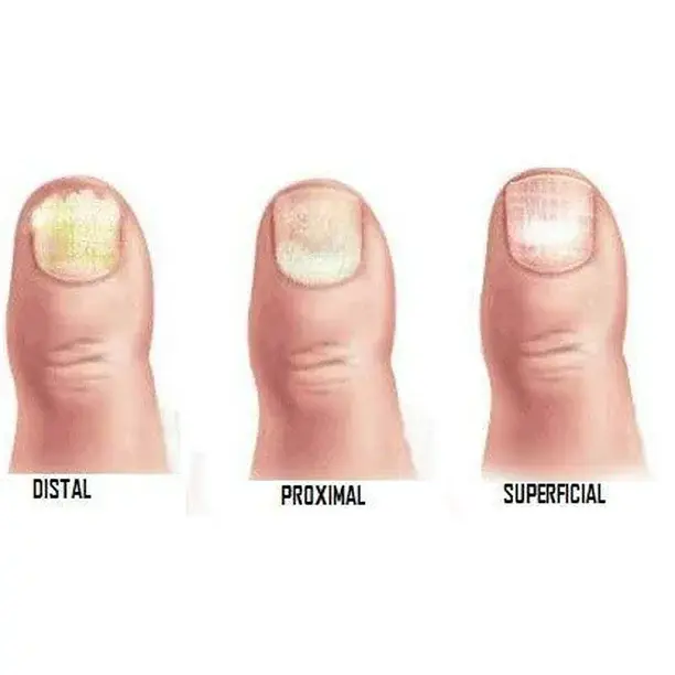 Thumbnail: Pro Nail Anti-fungal Liquid Solution .5 oz