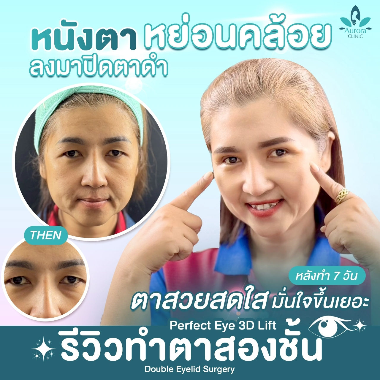 รีวิวทำตาสองชั้นกับคุณหมอเติ้ง | Double Eyelid Surgery by Dr.Apiruk, Plastic Surgeon รีวิวทำตาสองชั้นกับคุณหมอเติ้ง | Double Eyelid Surgery by Dr.Apiruk, Plastic Surgeon