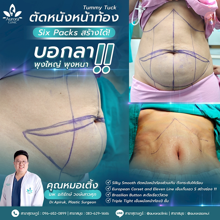 ซิคแพคสร้างได้!!! บอกลาพุงใหญ่ พุงหนา ด้วยการตัดหนังหน้าท้อง เทคนิค SEBT เปลี่ยนให้หน้าท้องสวยตึงกระชับ ปรับให้สะดือเรียววี หุ่นเป๊ะ ใส่เสื้อผ้าสวย มั่นใจ by หมอเติ้ง ศัลยแพทย์ตกแต่ง ซิคแพคสร้างได้!!! บอกลาพุงใหญ่ พุงหนา ด้วยการตัดหนังหน้าท้อง เทคนิค SEBT เปลี่ยนให้หน้าท้องสวยตึงกระชับ ปรับให้สะดือเรียววี หุ่นเป๊ะ ใส่เสื้อผ้าสวย มั่นใจ by หมอเติ้ง ศัลยแพทย์ตกแต่ง