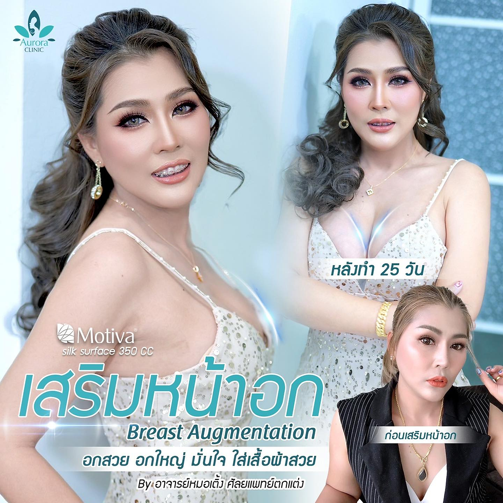 เสริมหน้าอก เทคนิค Aura Hybrids “แผลเล็ก เจ็บน้อย ไร้เลือด ไม่ต้องนวด” ปลอดภัย ผ่าตัดในโรงพยาบาล Breast Augmentation Motiva 350 cc by Dr.Apiruk, Plastic Surgeon