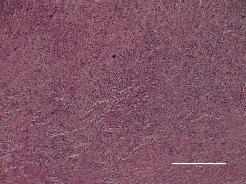 H+E Staining of a patient GBM sample, diplaying overabundance of cells within this tumor region
