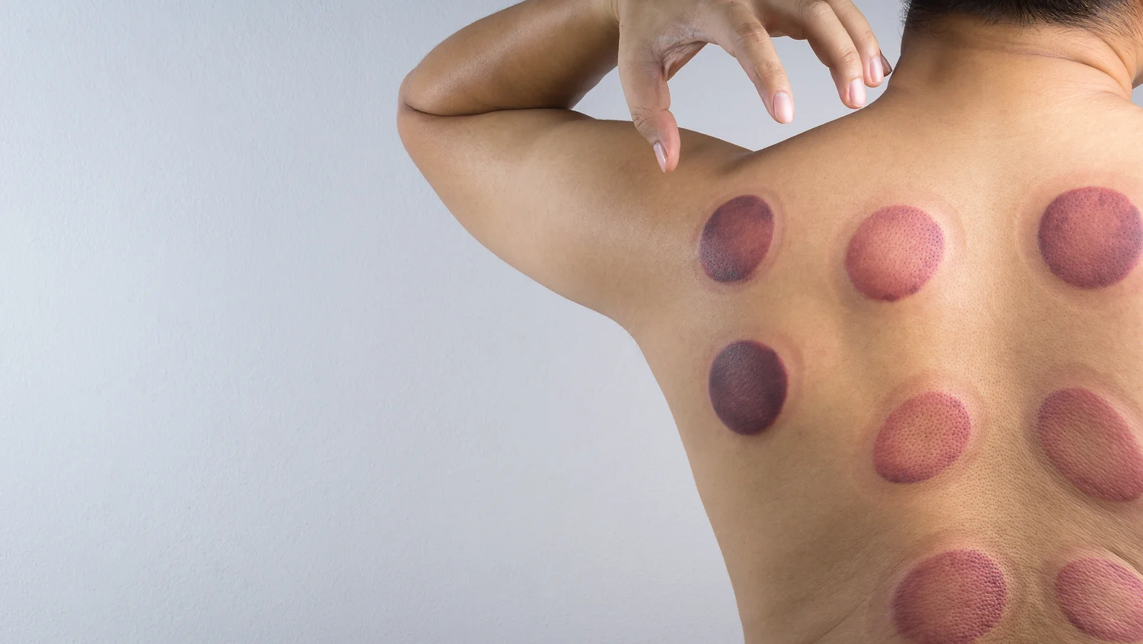 Advanced Cupping Techniques for the Upper Extremities