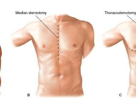 It's Medical Monday! Median Sternotomy