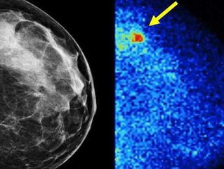 Mayo doctors in La Crosse call breast cancer screening tool an early success