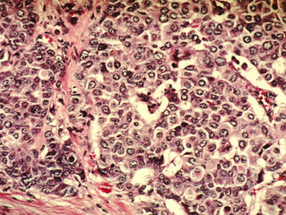 New discovery could open up PARP inhibitors to more cancer patients