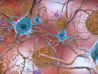 Exercise could slow withering effects of Alzheimer's