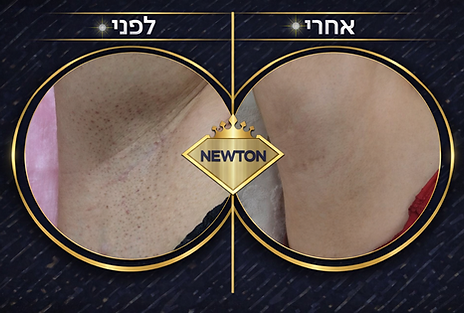 טיפול הסרת שיער בלייזר במכשיר ניוטון תמונות לפניי ואחריי שיפור 95%