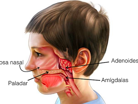 Cirurgia de adenoamÃgdala para crianças: quando é necessária
