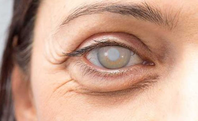 Visao-olhos-catarata-saude-500x306.jpg