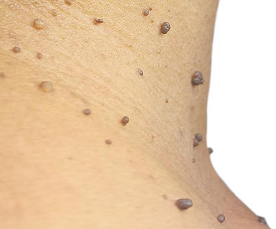 skin-tags (1).jpg