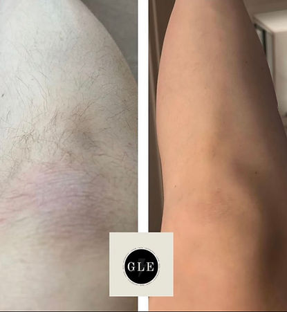 Laser hair removal at GLE Aesthetics