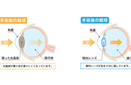 白内障の検査、手術、治療