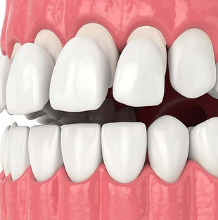 Composite-Veneers-1_edited.jpg