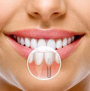 implant-tedavi-sonrasi.jpg