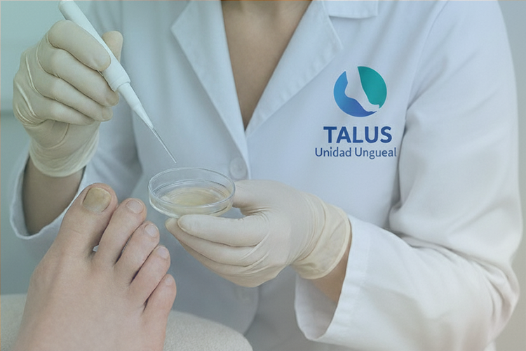 Onicomicosis: Una infección frecuente en las uñas