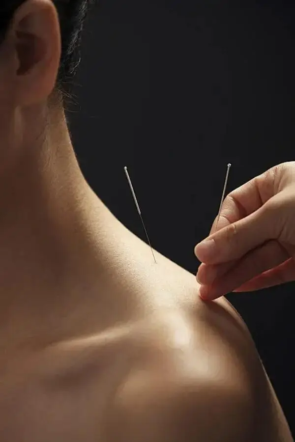Traditional Chinese Medicine acupuncture treatment with needles used during a TCM wellness experience in Beijing