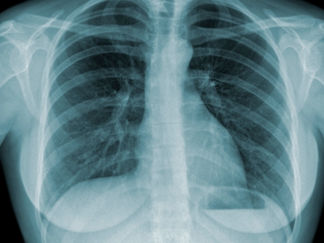 Epidemia de tuberculose é mais grave do que se pensava, diz OMS