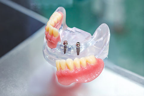 Removable acrylic denture