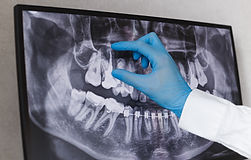 Doctor points to filled root canal in dental x-ray