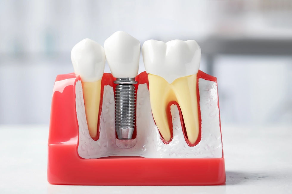 Dental implant model showing how implants replace missing teeth and support jawbone health
