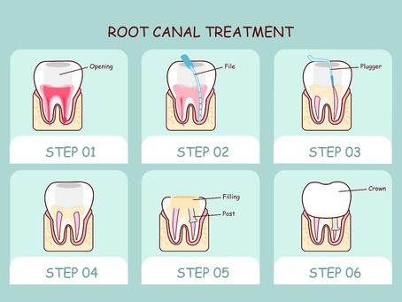 Diagram showing the six steps of root canal treatment with instruments and tooth layers.