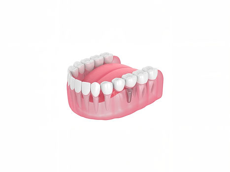 Dental implantation