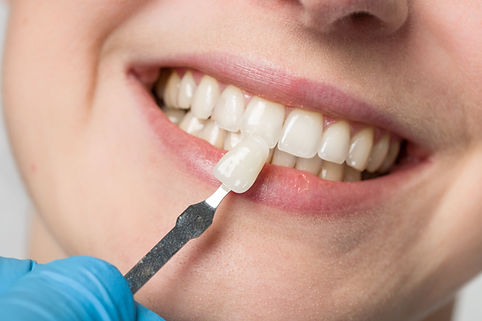 Dentist holding a shade guide to a patient's teeth