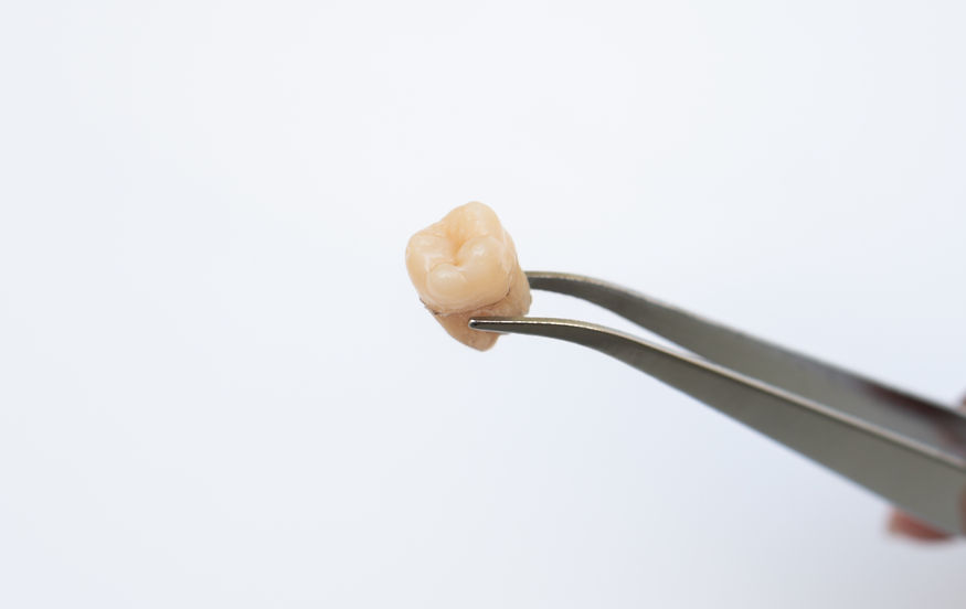 Tweezers holding an extracted wisdom tooth