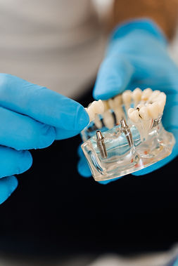 Dentist's gloved hands holding clear dental model with two implants.