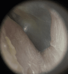 Ear-Canal-after.png