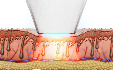 熱破壊式レーザーのメリット