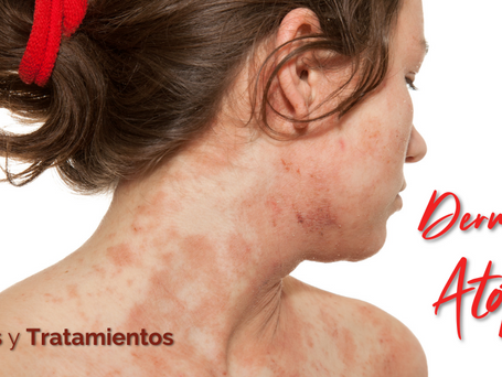 Dermatitis Atópica