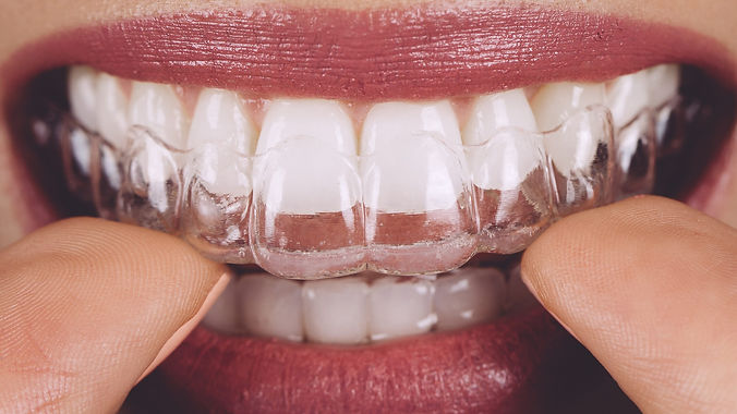 invisalign.jpeg