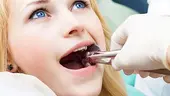 Tooth Extraction