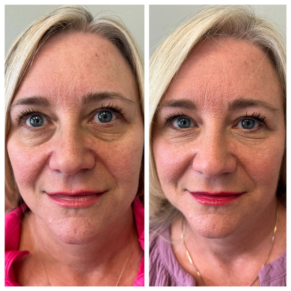 Under Eye PRF before and after.