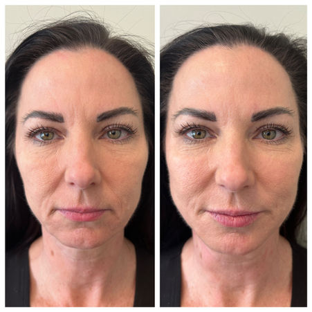 Hyperdilute Radiesse before and after.