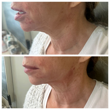 PDO Thread lift for neck before and after.