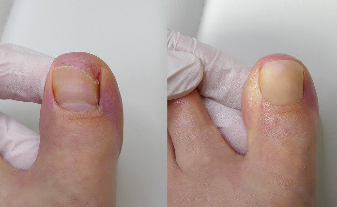 Nagel Reparatur Fuss