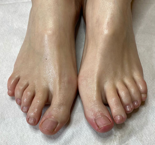 Fachfusspflege Foto nach der Behandlung