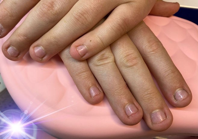 Nagelbeisser vorher Frau zu Frau Schänis