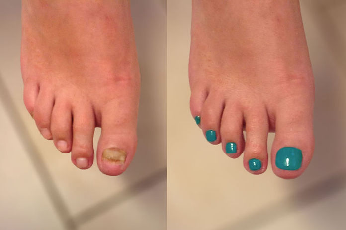 Rekonstruktion Fussnagel