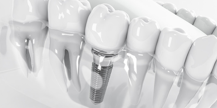 インプラント治療