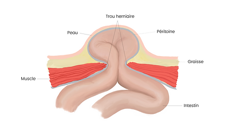 Hernien2_FR.png