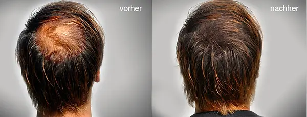 vorher_nachher_markus_n.webp