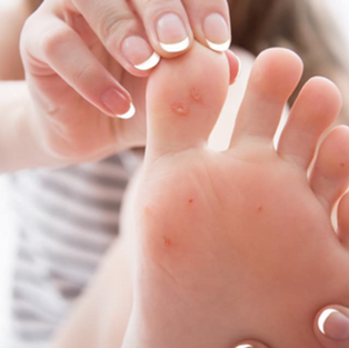 Wart removal, verruca freezing, wart freezing, verruca removal, cryopen freezing 