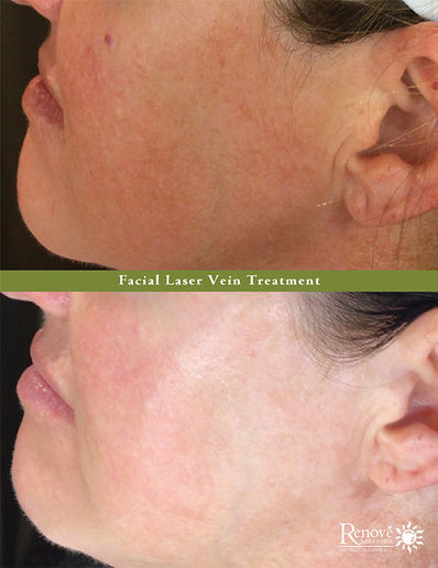 Before & After: Facial Laser Vein Treatment
