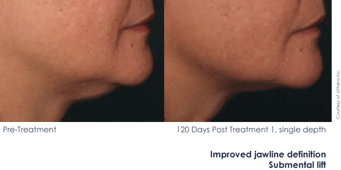 Ultherapy Improved Jawline Definition Submental Lift