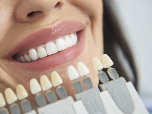 Eight incredible benefits of teeth whitening in Beckenham 